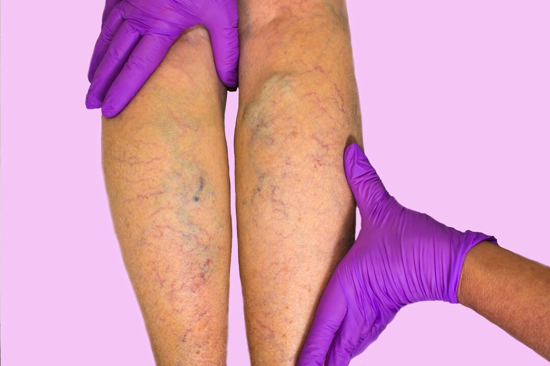 varicose veins in the legs