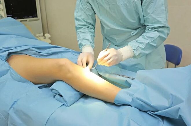 Flexolectomy