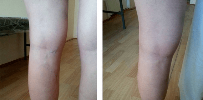 varicose veins in the legs