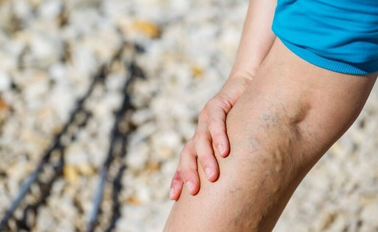 Varicose veins in the legs